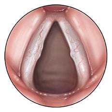 Nódulos de las Cuerdas Vocales, Vocal Cord Nodules and Polyps Treatment Program - Dr. Gerardo López Guerra