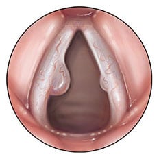 Quistes de las Cuerdas Vocales - Vocal Cord Cysts Treatment Program - Dr. Gerardo López Guerra