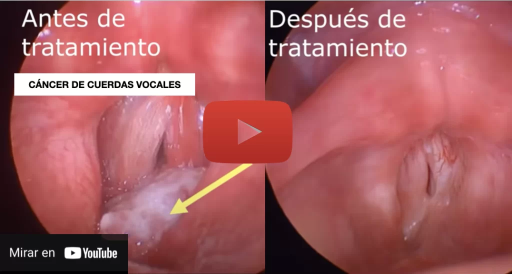 Tratamiento del cáncer de laringe - Dr. Gerardo López Guerra