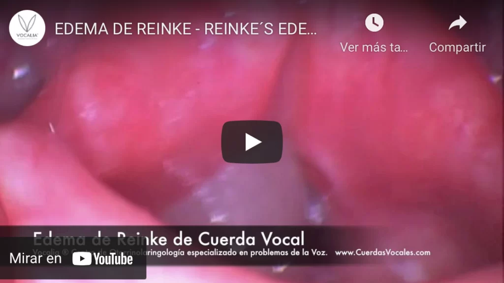 Edema de Reinke - Pólipos Nódulos de las Cuerdas Vocales - Vocal Cord Nodules and Polyps Treatment Program - Dr. Gerardo López Guerra