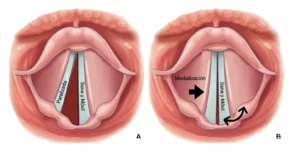 Tratamiento de la Parálisis de cuerdas vocales - Dr. Gerardo López Guerra