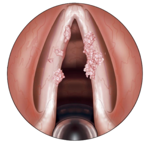 Papilomatosis Laríngea Recurrente, Papiloma de Cuerdas Vocales / Laryngeal Recurrent Papilloma Treatment - Dr. Gerardo López Guerra