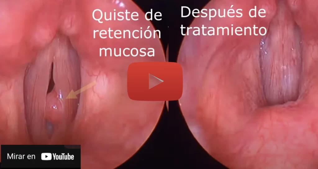 Quistes de las Cuerdas Vocales - Vocal Cord Cysts Treatment Program - Dr. Gerardo López Guerra