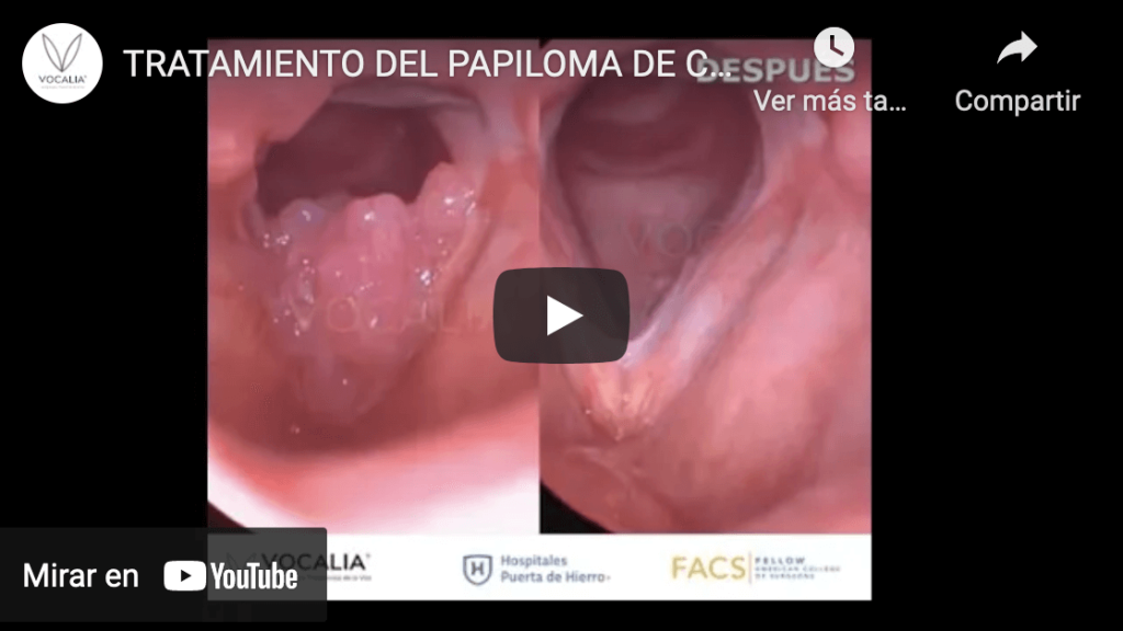 Papilomatosis Laríngea Recurrente, Papiloma de Cuerdas Vocales / Laryngeal Recurrent Papilloma Treatment - Dr. Gerardo López Guerra