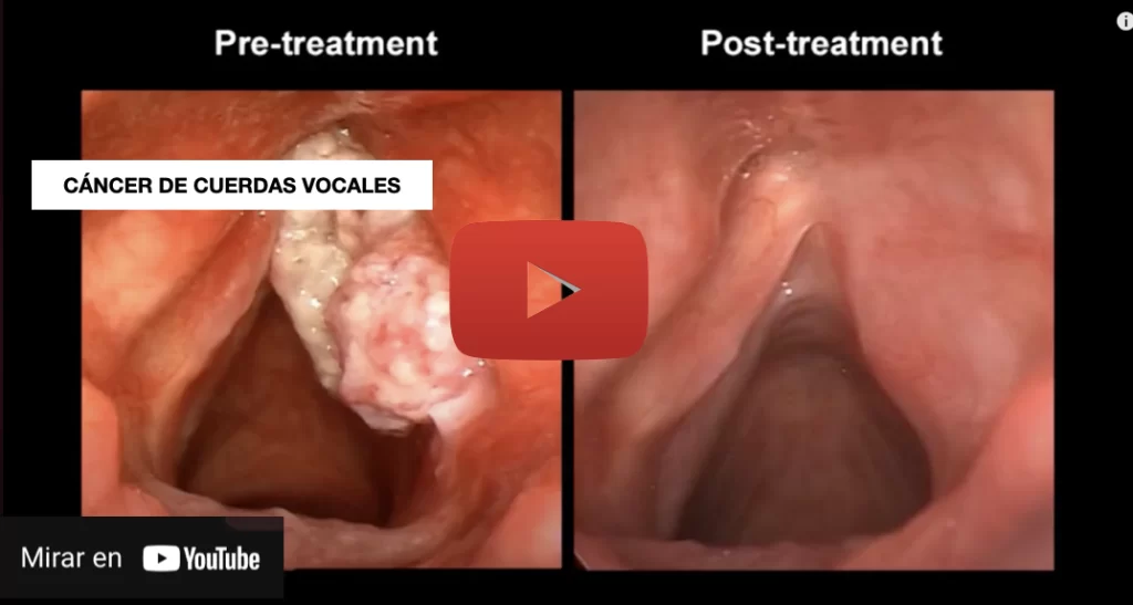 Tratamiento del cáncer de laringe - Dr. Gerardo López Guerra